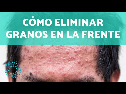 Despeja tu frente: Cómo quitar los granos de forma fácil y efectiva