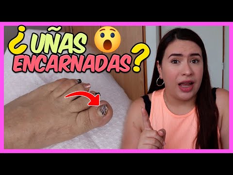 Guía rápida: Cómo cortar la uña para evitar su encarnación