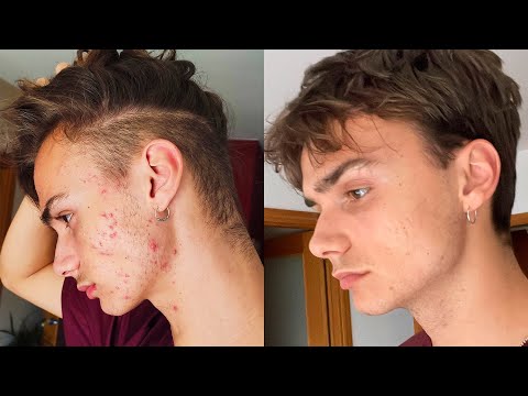 Elimina granos de la cara en un día: Métodos efectivos