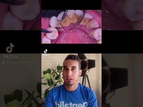 Elimina el Sarro Dental en Casa: ¡Aprende Cómo!