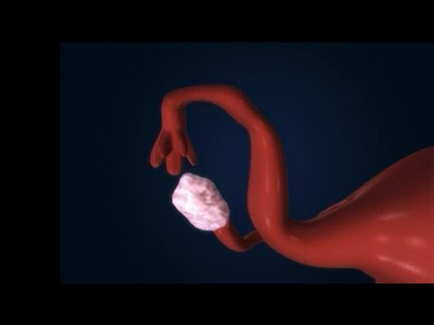Revertir la ligadura de trompas de forma natural: métodos y consejos