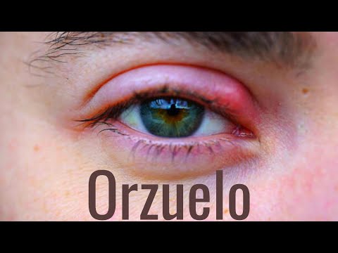 Quitar un orzuelo con una cuchara: método efectivo y fácil