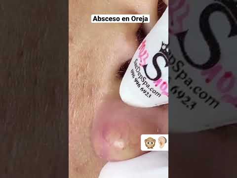 Elimina el bulto en el lóbulo de la oreja: Guía completa