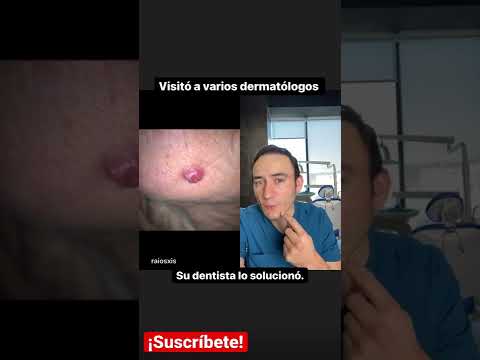 Aplicar pasta de dientes en los granos: ¡Descubre cómo hacerlo correctamente!