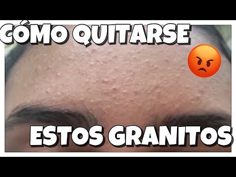 Consejos para disimular granos en la frente de forma efectiva