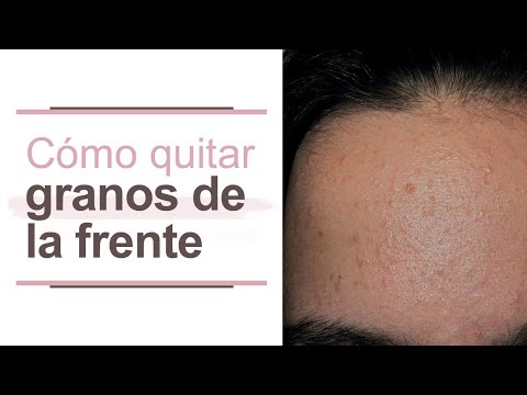 Elimina granos en la frente en una noche: trucos efectivos