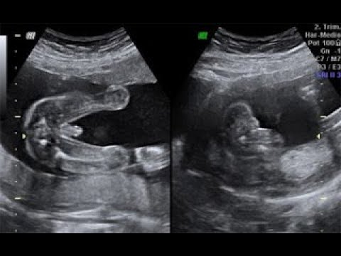 Descubre cómo saber el sexo del bebé en el ultrasonido