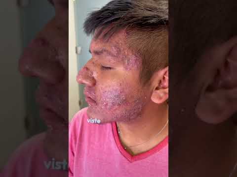 Seca los granos de la cara rápido: Consejos efectivos