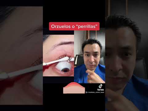 ¿Cómo saber si un orzuelo está enquistado? Guía completa