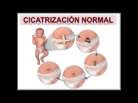 ¿Cómo queda el ombligo tras caer el cordón umbilical?
