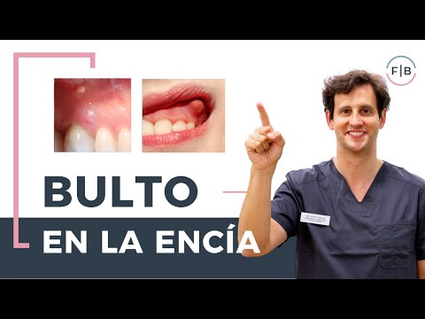 Bulto en la encía: Cómo quitarlo de forma efectiva