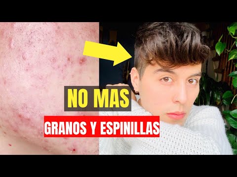 Elimina espinillas en la barbilla: consejos efectivos