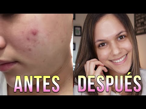 Elimina granos en una noche con remedios caseros