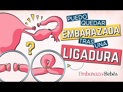 Quedar embarazada con ligadura de trompas: Métodos y consejos