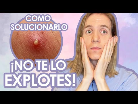 Elimina granos internos de la cara: cómo hacerlo fácilmente