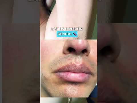 Remedios naturales para curar los granos de Fordyce en los labios