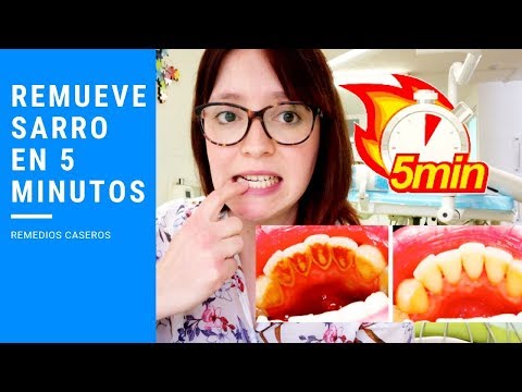 Elimina el sarro dental sin visitar al dentista: consejos y trucos efectivos