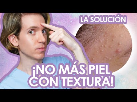 Elimina granitos en la frente: consejos efectivos