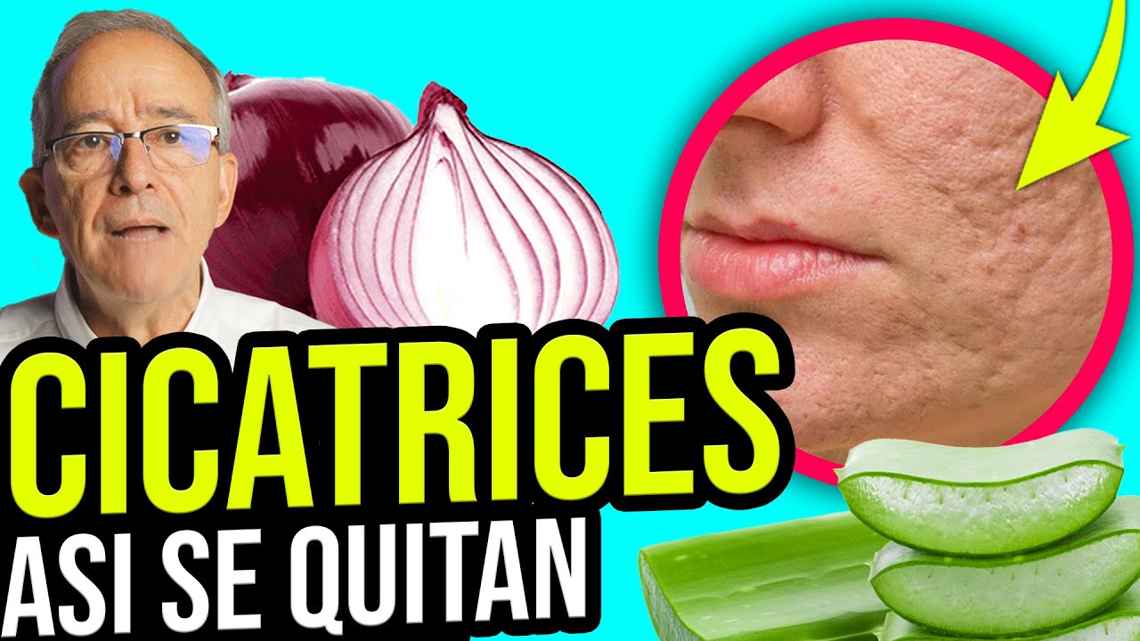 como eliminar cicatrices de acne profundas de forma natural