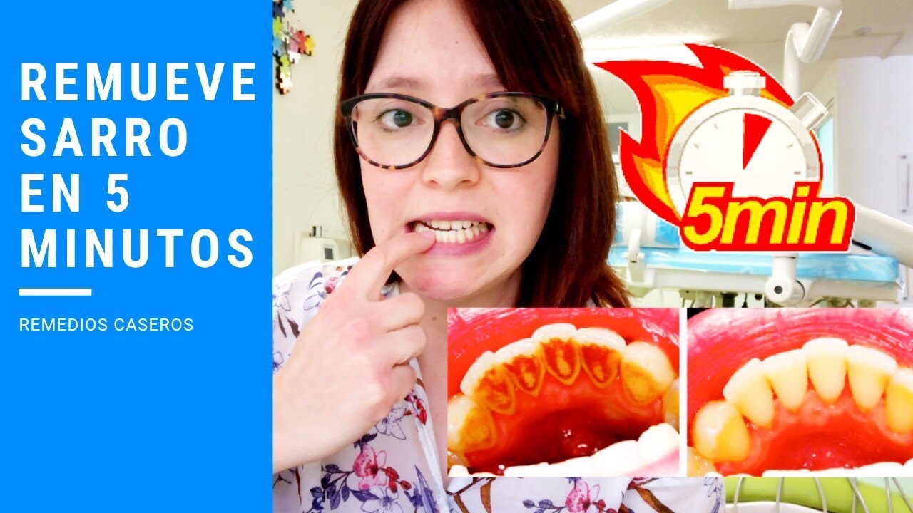 como eliminar los sarros de los dientes con remedios caseros