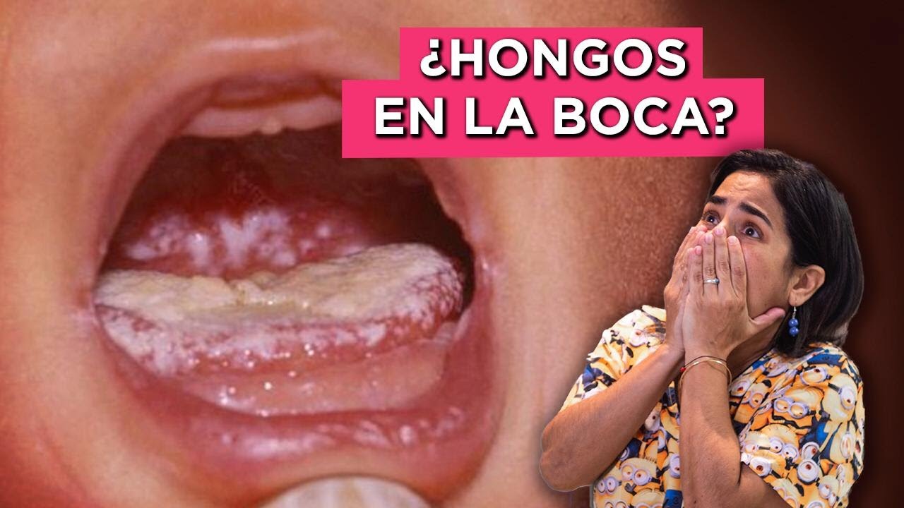 como es el algodoncillo en la boca