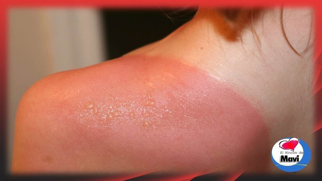 como quitar lo rojo de quemadura del sol