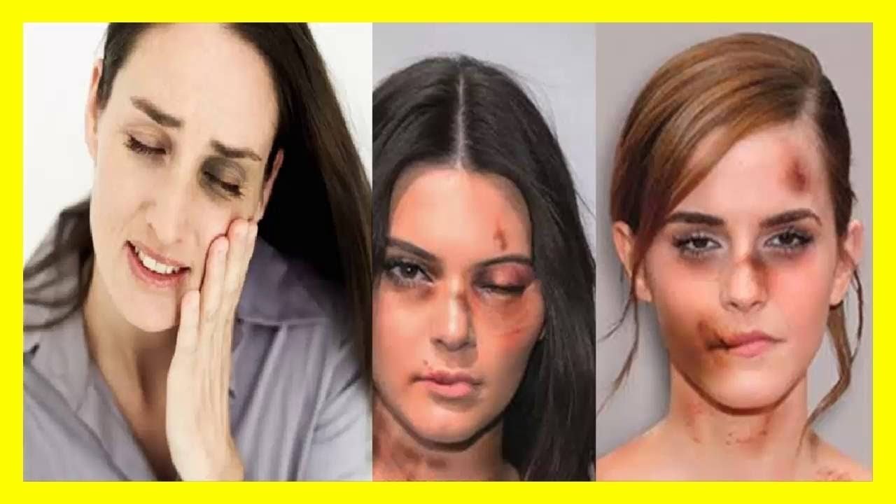 como quitar los moretones de la cara