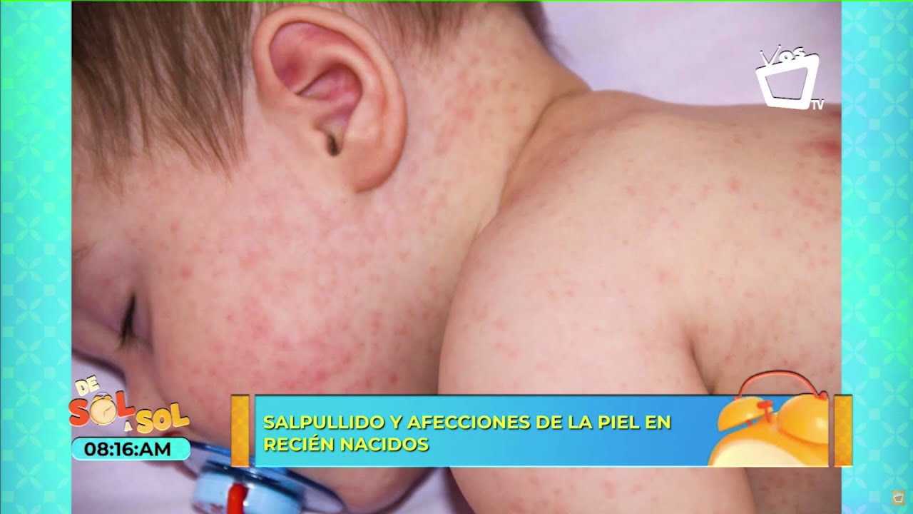 como curar el sarpullido en la cara de los bebes
