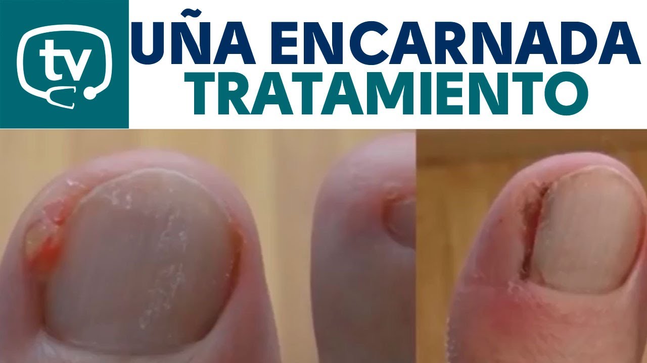 como desenterrar una una del pie sin dolor en casa