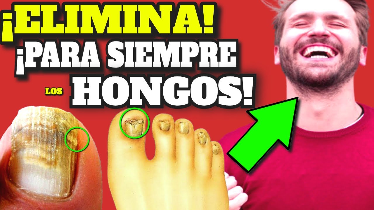 como eliminar las unas amarillas y gruesas de los pies