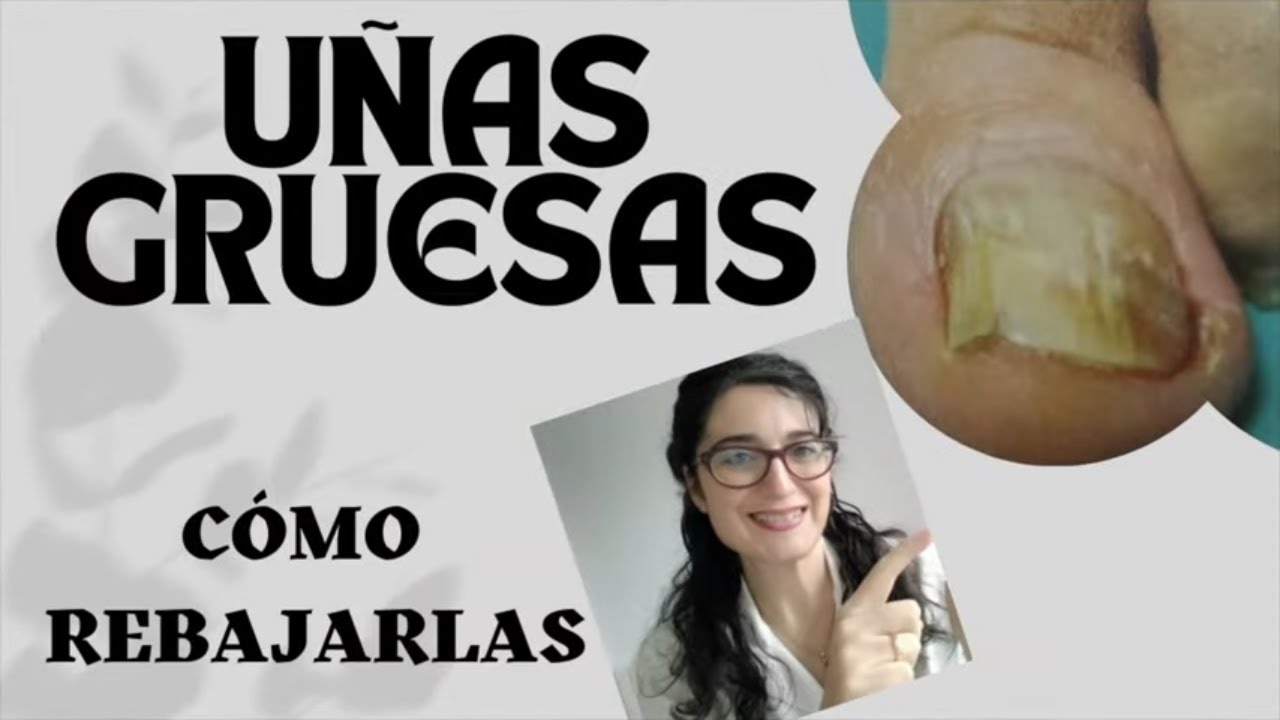 como eliminar las unas gruesas de los pies