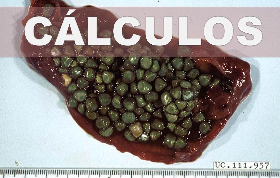 como eliminar piedras de la vesicula con remedios naturales