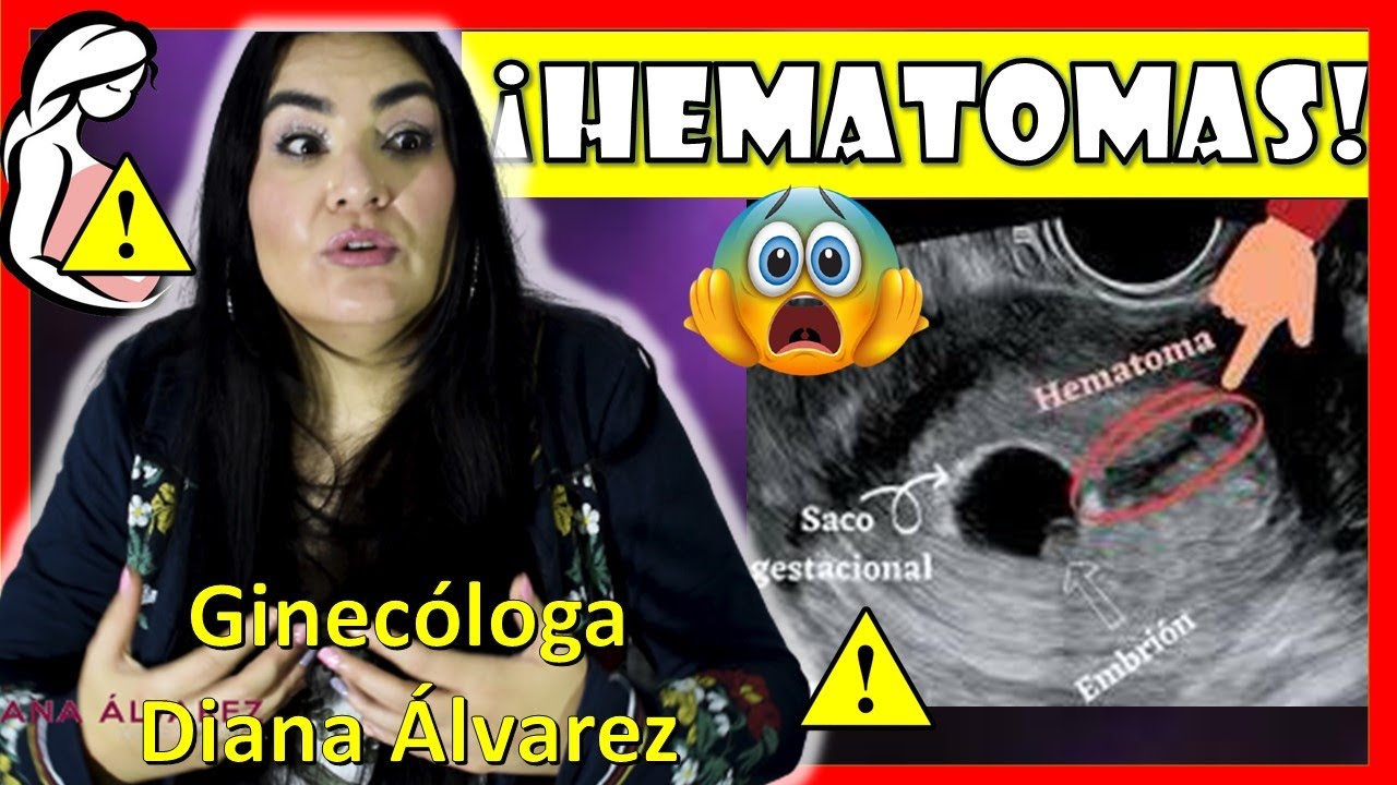 como es un hematoma en el embarazo