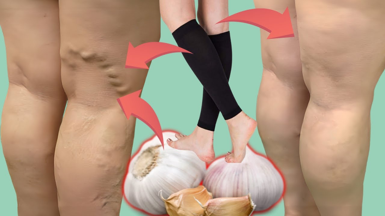 como quitar las varices en una semana remedios caseros