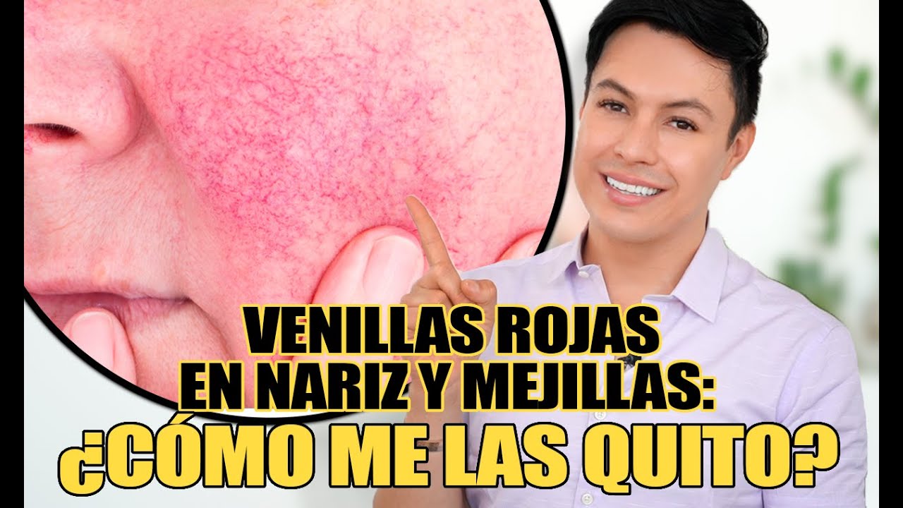 como quitar las venitas de la cara en una semana