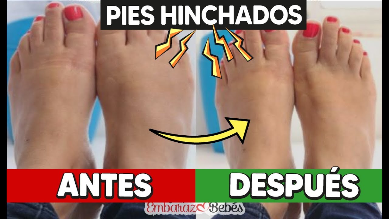 como quitar lo hinchado de los pies en el embarazo