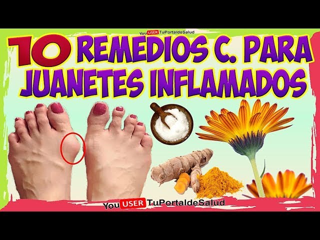 como quitar los juanetes con remedios caseros