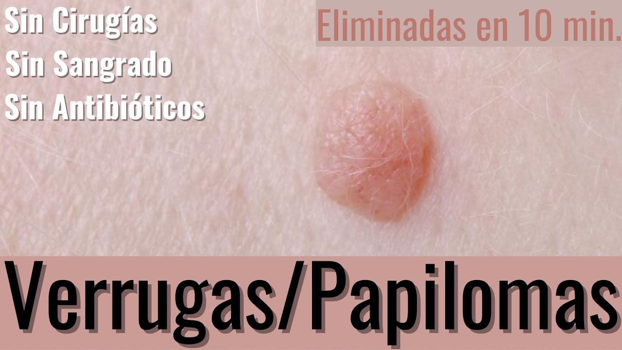 como quitar una verruga en el lagrimal del ojo