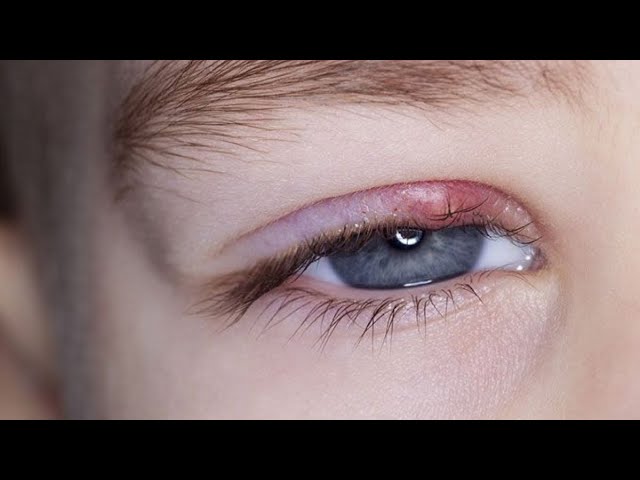 como sale una perrilla en el ojo